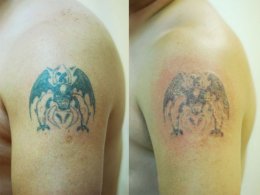 Удаление татуировки лазером (ФОТО)