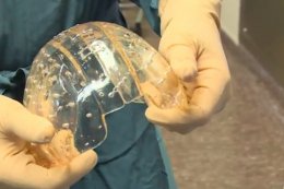 Врачи провели операцию по пересадке черепа, напечатанного на 3D-принтере (ВИДЕО)