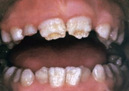 Ученые разработали технологию для восстановления разрушенных зубов