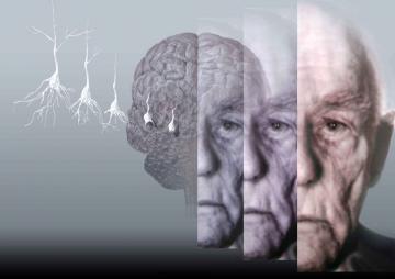 Революция в медицине, создано первое лекарство от болезни Альцгеймера