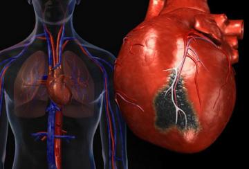 Ученые пересмотрели терапию инфаркта