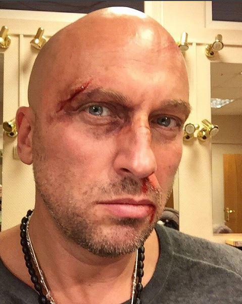 Дмитрий Нагиев показал снимок с разбитым лицом (ФОТО)