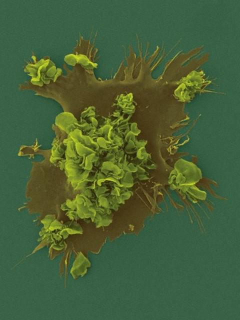Иммунные клетки помогают раку сопротивляться радиации