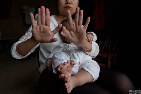 Уникальный случай. В Китае родился мальчик с 31 пальцем (ФОТО)
