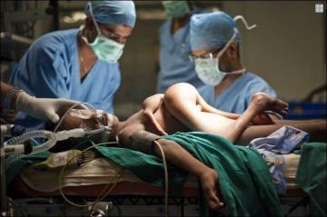 Индийскому мальчику с восьмью конечностями провели сложную операцию