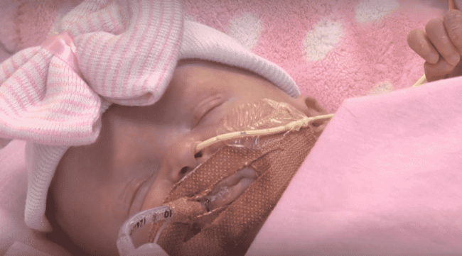 Впервые в истории медики спасли ребенка, родившегося с сердцем за пределами тела