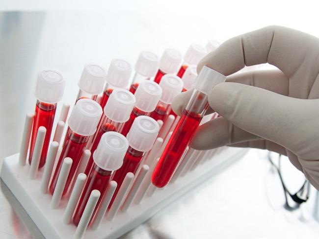 Ученые разработали новый вид анализа крови для выявления рака на ранней стадии