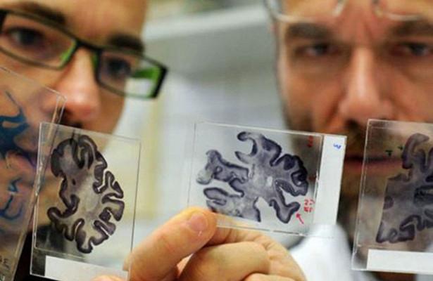 Ученые «взломали» болезнь Альцгеймера