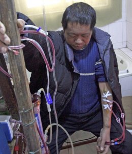 Китаец смастерил себе искусственную почку из кухонных принадлежностей (ФОТО)