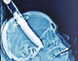 Парню всадили нож в голову по самую рукоятку