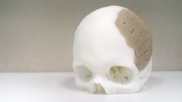 Пациенту напечатали череп на 3D-принтере (ФОТО)