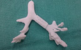 Напечатанный 3D-имплантат спас жизнь ребенку (ФОТО+ВИДЕО)