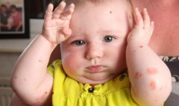 Редкая и очень неприятная болезнь