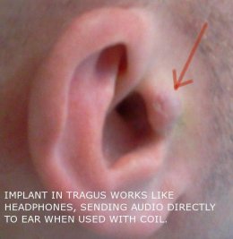 В США провели операцию по вживлению динамика в ухо (ФОТО)