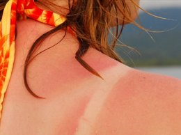 Ученые нашли способ, как избавить людей от солнечных ожогов