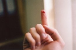 Американские врачи вырастили пациенту новый палец