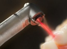 В восстановлении поврежденных зубов помогут лазеры