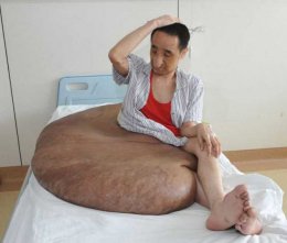 Китайские врачи удалили мужчине 108-килограммовую родинку (ФОТО)