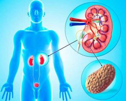 Причина камней в почках - глобальное потепление