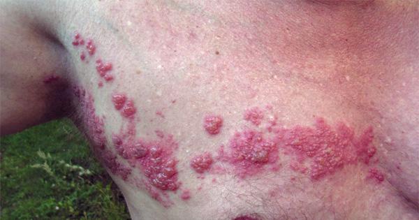 Коварство герпеса (ФОТО)