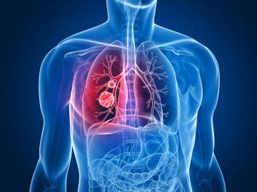 Рак легких научились определять по дыханию