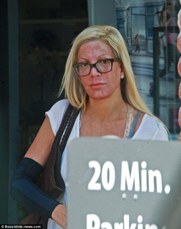 Звезда сериала “Беверли Хиллз 90210” изуродовала лицо в спа-салоне (ФОТО)