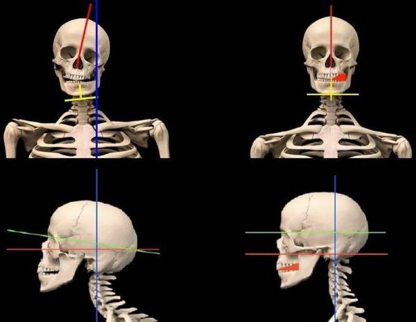 Привлекательность лица, и осанка зависят от … прикуса!