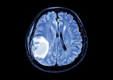 Ученые предложили действенный метод лечения опухолей мозга
