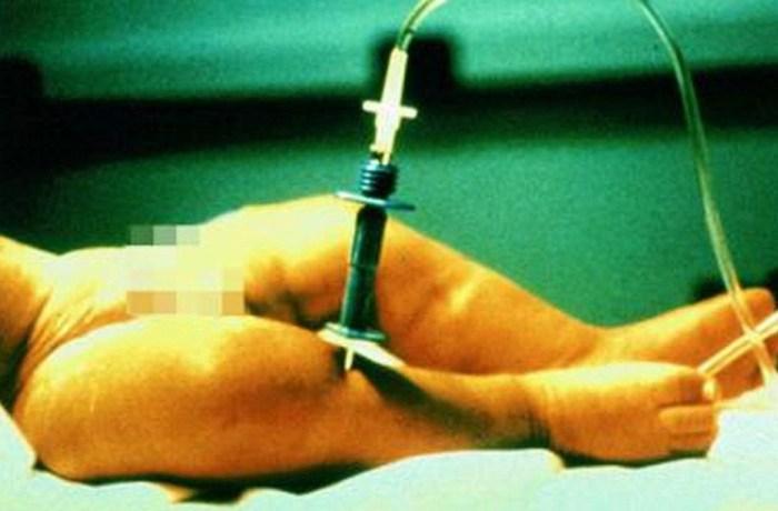 10 страшных медицинских процедур, которые используются до сих пор (ФОТО)