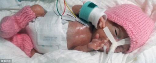Родилась самая маленькая девочка в мире (ФОТО)