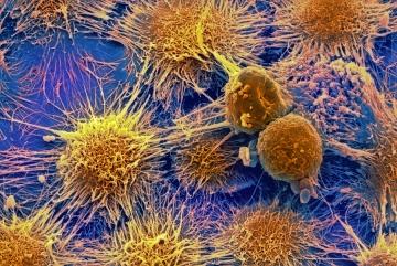 Ученые назвали основные факторы риска смертности от рака