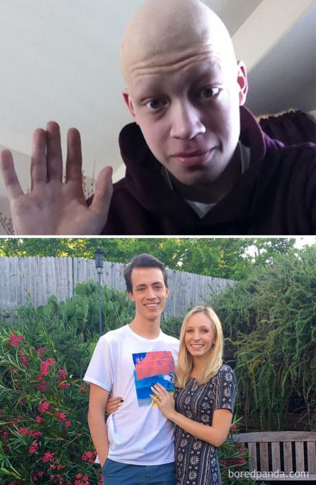 Они смогли победить рак: мощные снимки людей «до и после» (ФОТО)