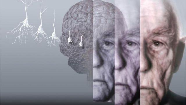 Американские медики рассказали, как замедлить развитие болезни Альцгеймера